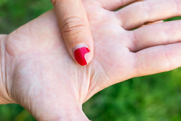 ongle cassé